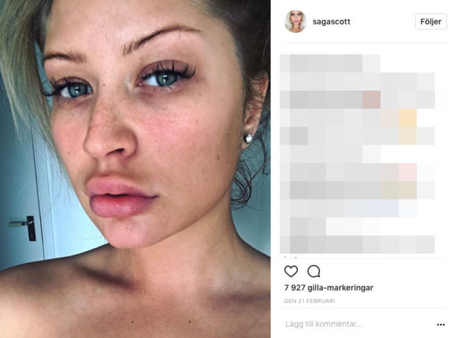 blåmärken efter fillers blåmärken efter fillers